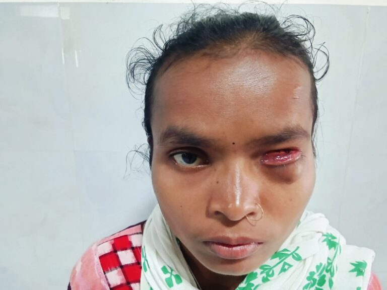 ଗୋଟିଏ ଆଖି ନଥାଇବି ମିଳୁନାହିଁ ଭତ୍ତା